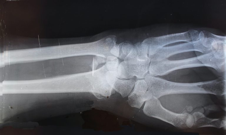 Assessment of fractures