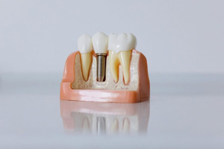 Why Dental Implants Are Changing Smiles Across the Globe